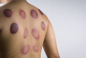 Cupping mark